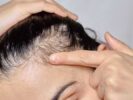 Equilibrio hormonal y la salud del cabello