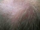 Psoriasis capilar y pérdida del cabello