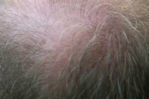 Psoriasis capilar y pérdida del cabello