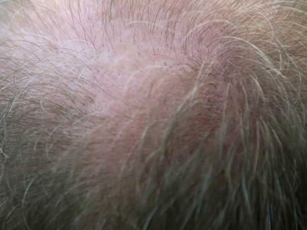Psoriasis capilar y pérdida del cabello